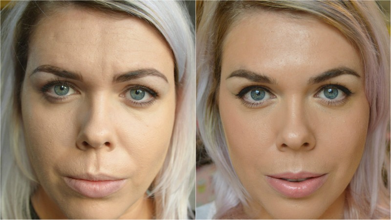 Before and After Micro botox pictures