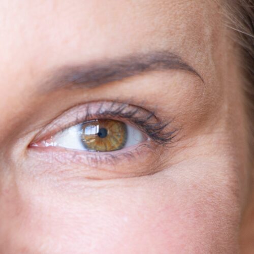 Botox for Under Eye Wrinkles